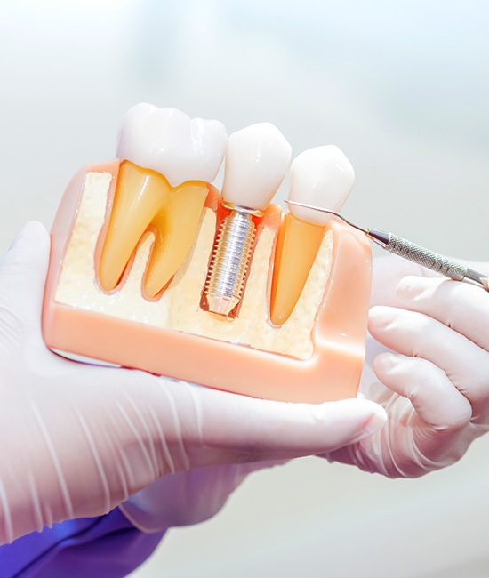 The image displays a dental model with artificial teeth and gums, showcasing a dental implant fixture with a screw visible above the lower front teeth. A pair of hands wearing medical gloves are holding the model, indicating a medical or dental context.
