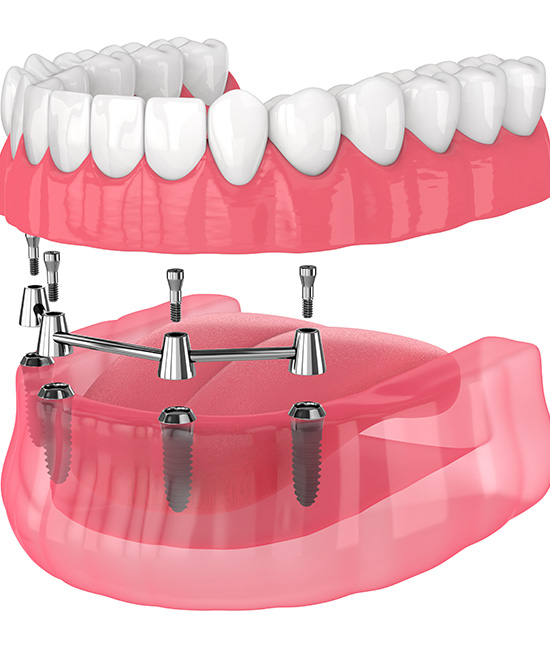 The image shows a pink, clear dental impression tray with teeth and gum details, mounted on a metal stand with screws visible.