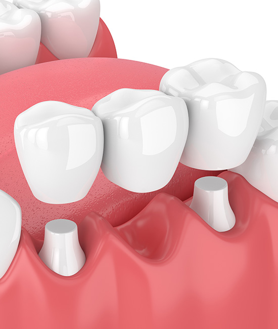 An image of a 3D rendering of a human mouth with teeth and gums, showcasing dental implants.
