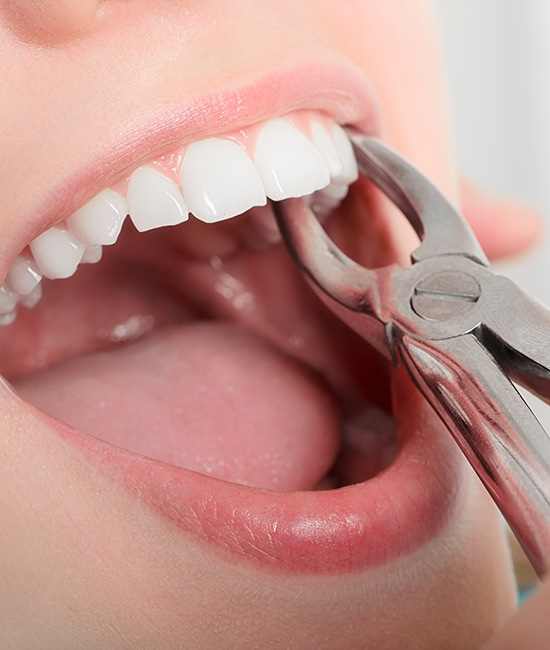 The image shows a close-up of a person s mouth with teeth being worked on, featuring dental tools and the oral cavity.
